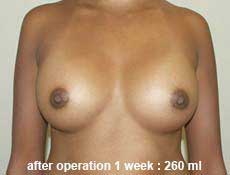 plastic-surgery-breast-augmentation 